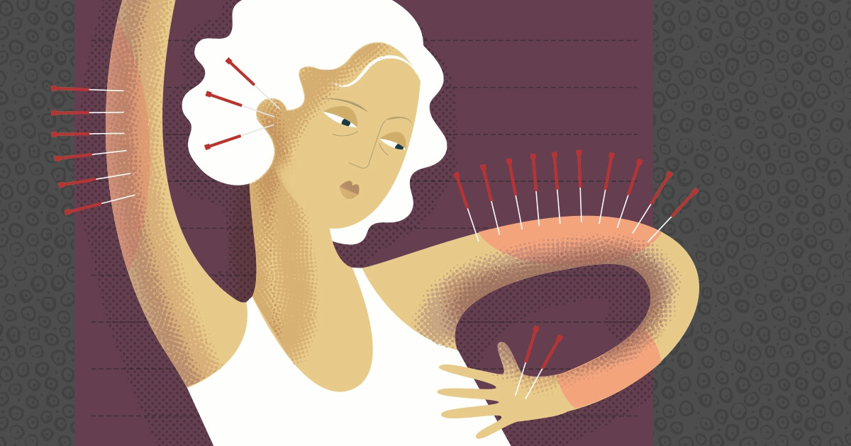 Acupuncture Relieves TreatmentRelated Joint Pain in Breast Cancer