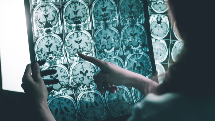 Cellular Stress Response Research Yields Insights Into Alzheimers and ALS